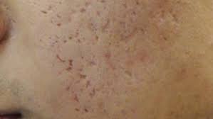 Inilah Cream Untuk Bekas Jerawat Berlubang Yang Cepat Hasilnya Bekas Jerawat Wajah