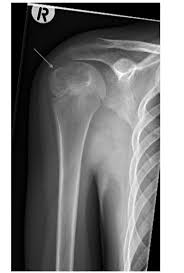Image result for Humerus Growth Plates