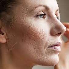 Microneedling Little Rock, AR