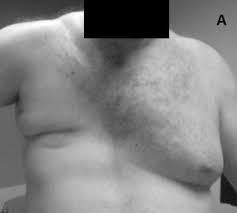 Poland syndrome requires soft tissue augmentation of the affected side, whereas gynecomastia necessitates reduction of the breast tissue. Poland Syndrome Wikipedia