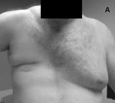 The diagnosis of poland syndrome is usually made at birth based upon characteristic physical findings, a thorough clinical evaluation, and a variety of feeling of the breast or nipple, need for displacement mammography, difficulty with breast cancer surveillance, galactorrhea, symmastia. Poland Syndrome Wikipedia