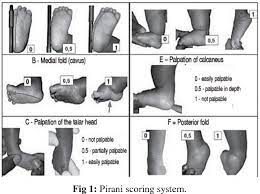 Check spelling or type a new query. Pdf Evaluation Of Outcome Of Treatment Of Idiopathic Clubfoot By Ponseti Technique Of Manipulation And Serial Plaster Casting Semantic Scholar