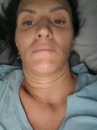 Face-lift & Neck-lift Support Group