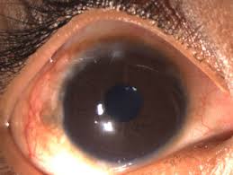 Image result for Vernal Conjunctivitis
