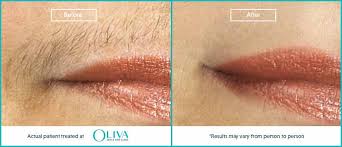 laser hair removal in chennai cost