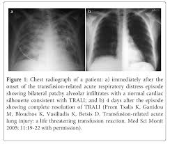 Image result for Transfusion Associated Circulatory Overload