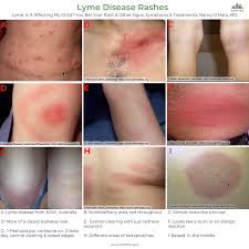 Ilads Lyme Disease Guidance Dr O Hara Aspire