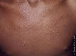Image result for skin rash similar to scabies