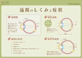 遠視はなぜ起こる どんな症状なの いしゃまち 看護ノート 医学 医療