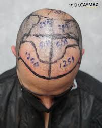 The truth is, any doctor whether it is an endocrinologist, dermatologist, or general practitioner with a strong interest and knowledge in hair loss can make a proper diagnosis and work with you on the the treatment they think will produce the best results. From Hair Loss To Hair Transplantation Hair Upload Clinic Dr Caymaz