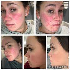 Soolantra (ivermectin cream) is only meant to be used on your face. Man It Was Bad Progress With Soolantra Rosacea