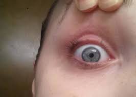The great lengths we go to for beauty can be painful!! Eyelash Curler Nightmare Woman S Sneeze Leaves Her Lashless National Globalnews Ca