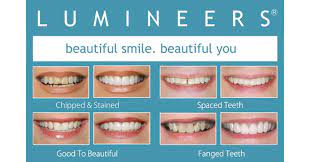 We did not find results for: Patient Questions Answered How Long Do Lumineers Last