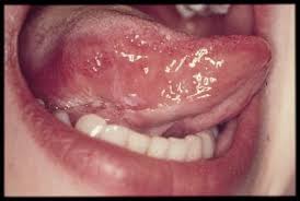 Image result for white cancer on tongue)