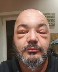 Todo domingo às 19h__ palavra:ev. Fernando Rocha Mostra Se Desfigurado Apos Fazer Implante Capilar A Ferver Vidas