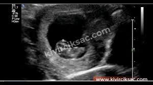 8 haftalik gebelik belirtileri kivircik sac doktorlar hamilelik menopoz