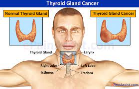 Men 2 tumors affecting the thyroid are medullary thyroid cancer. Thyroid Gland Cancer Causes Symptoms Treatment Surgery Harmone Chemo Therapy