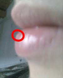 Diesen findet man heute noch an vielen stellen. Ich Hab Einen Buckel Auf Unterlippe Lippe Knoten