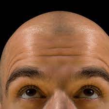 This causes more hair to fall out, sometimes in handfuls. The New Growth In Hair Loss Research Hair Loss The Guardian