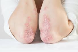 Image result for psoriasis