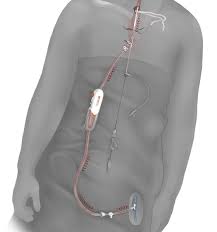 There are four carotid arteries, two on each side of the neck: Uh Contributes To Valuable Research For Patients With Carotid Artery Disease University Hospitals