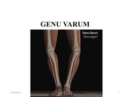 Image result for Genu Varum