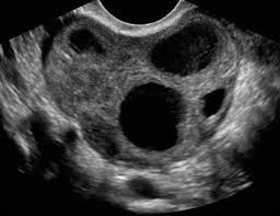 Aium Practice Guideline For Ultrasonography In Reproductive Medicine 2009 Journal Of Ultrasound In Medicine Wiley Online Library