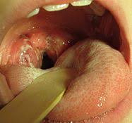 Lots of different health conditions can cause them. Streptococcal Pharyngitis Wikipedia