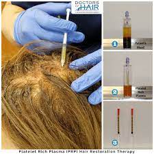 Platelet Rich Plasma Prp Hair Restoration Therapy Use Your Body S Own Plasma Fast Results Affordable And C Hair Restoration Prp Hair Hair Loss Spray