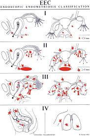 Endometriosis happens when the endometrium, tissue that usually lines the inside of your uterus, grows outside it. The Concept Of Endometriosis As Chronic Disease Surgical And Medical Therapy With Hormonal And Nonhormonal Targets And The Influence Of Endometriosis On Obstetrical Outcome Frontiers In Gynecological Endocrinology Volume 1 From