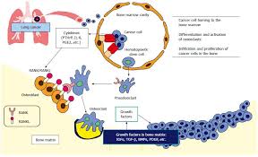 As in all cancers, the disease occurs because too many cells are created uncontrollably. Recent Aspects For Disseminated Carcinomatosis Of The Bone Marrow Associated With Gastric Cancer What Has Been Done For The Past And What Will Be Needed In Future