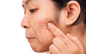 Common Hormonal Imbalances that Cause Acne - Dr Terry Loong