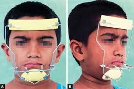 The Timing of Orthodontic Treatment
