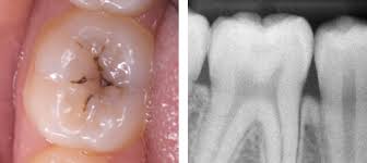 Image result for Occlusal
