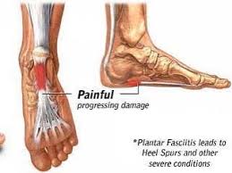 Plantar Fasciitis Is Inflammation Of The Thick Tissue On The Bottom Of The Foot This Tissue Is Calle Plantar Fasciitis Muscle Tenderness Tight Achilles Tendon