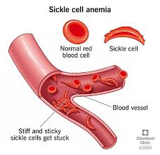 Medical illustration of normal red blood cells versus sickle cells blocking a blood vessel