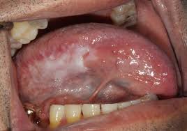 Image result for white cancer on tongue)
