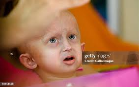 245 Progeria Stock Photos, High-Res Pictures, and Images