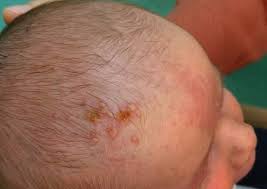 Image result for sores on the head in children