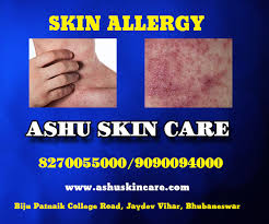 Thank you for visiting my website. Best Dermatologist In Bhubaneswar Skin Hair Treatment Specialist In Bhubaneswar Cuttack Odisha Ashu Skin Care