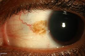 Image result for melanosis sclera