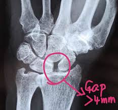 Image result for Scapholunate Dislocation