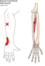 Dry Needling Tennis Elbow Which Extensor Xeri