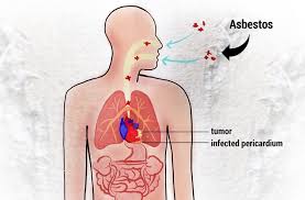 Mesothelioma is a cancer that most commonly starts in the layers of tissue that cover eac. Mesothelioma Meaning Miho