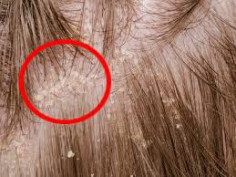 Combate El Sebo Y La Caspa Del Cabello Con Este Remedio En 2020 Cabello Grasoso Caspa Cabello Caspa