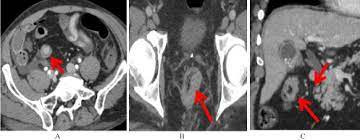 What does a ct scan show? Detecting Early Colorectal Cancer On Routine Ct Scan Of The Abdomen And Pelvis Can Improve Patient S 5 Year Survival