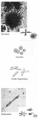 Cristaux oxalate de calcium à travers ces urines traitement. Developpement Et Sante Les Cristaux Urinaires