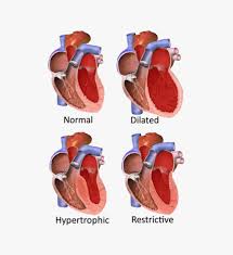 Image result for Restrictive Cardiomyopathy