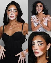 Ella es la primera mujer con vitíligo la cual participará en MISS UNIVERSE  2024. La bella Logina Salah, Miss Universe Egipto 2024 primera mujer con  vitiligo que pisará el certamen universal más