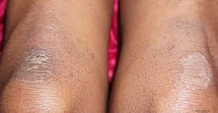 Like Magic Vlogger Gets Rid Of Dark Spots On Knees With Callus Remover Callus Removal Dark Spots Dark Spots On Legs